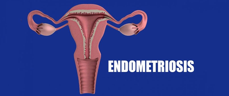 Endometriosis Treatment