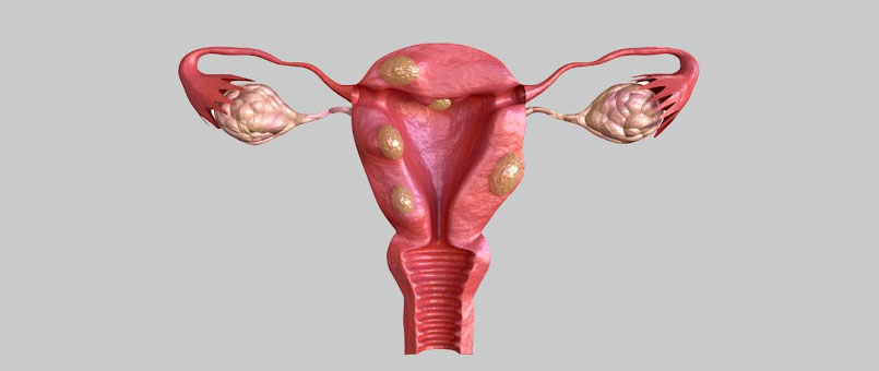 uterine-fibroids-treatment