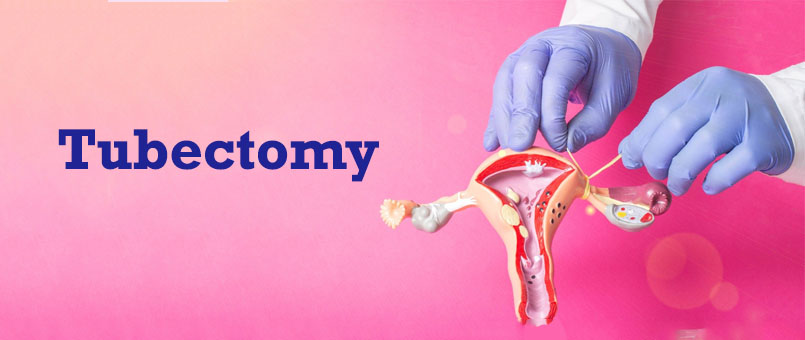 Tubectomy